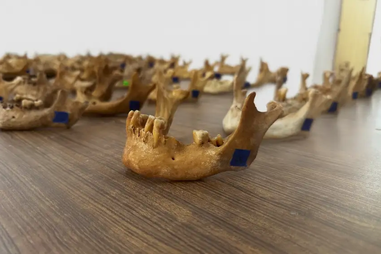 Periodontitis: la enfermedad bucal olvidada