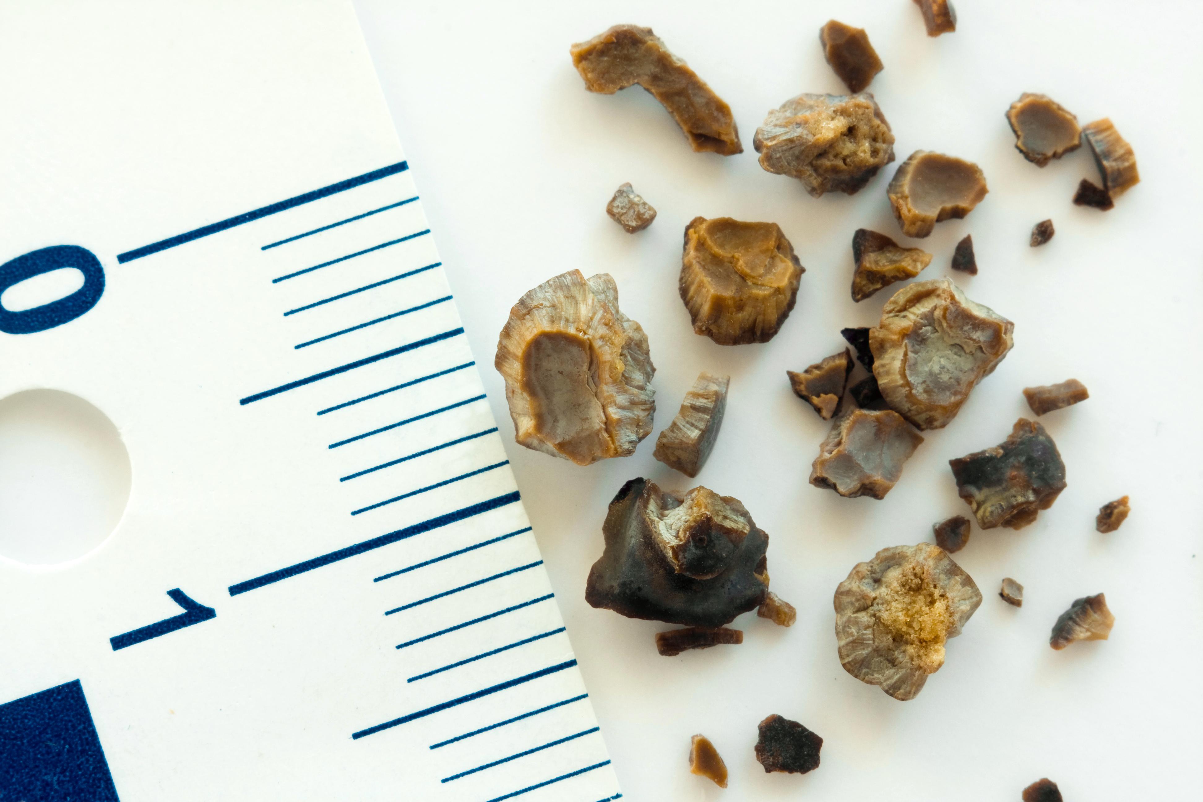 Piedras en el riñón: un problema de salud pública en Yucatán