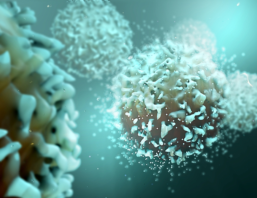 Diagnóstico oportuno en Yucatán de linfoma de células del manto: especialista