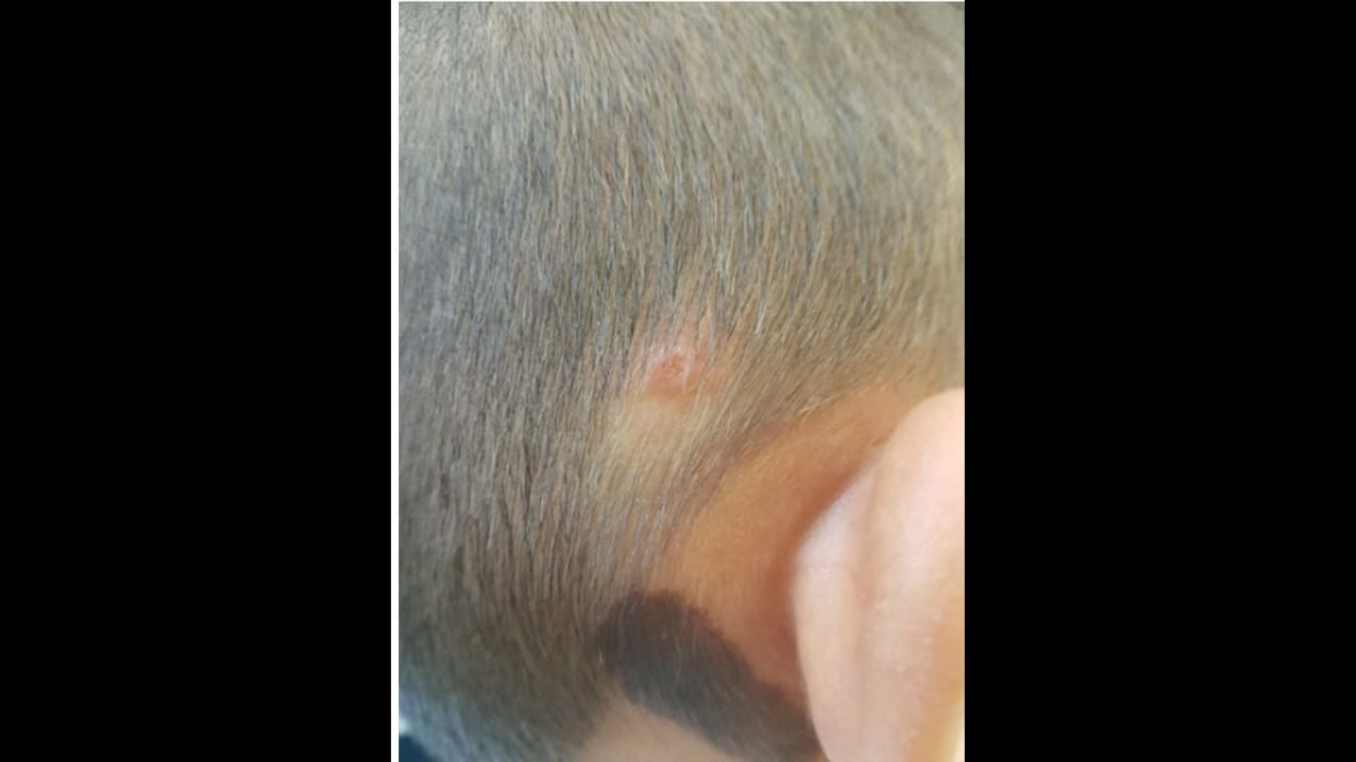 Documentan el primer caso urbano de rickettsiosis en México en un paciente de Mérida, Yucatán