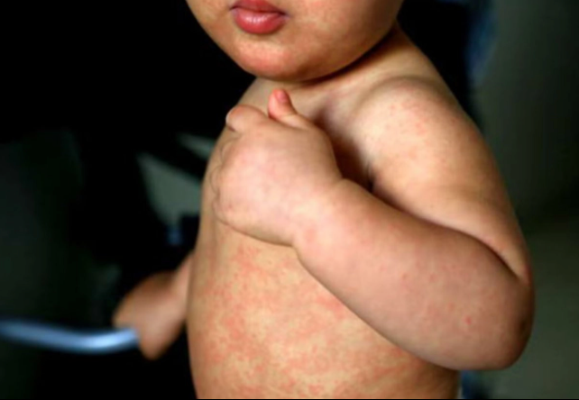 Ssa confirma una muerte más por sarampión; suman 36 desde inicio del brote