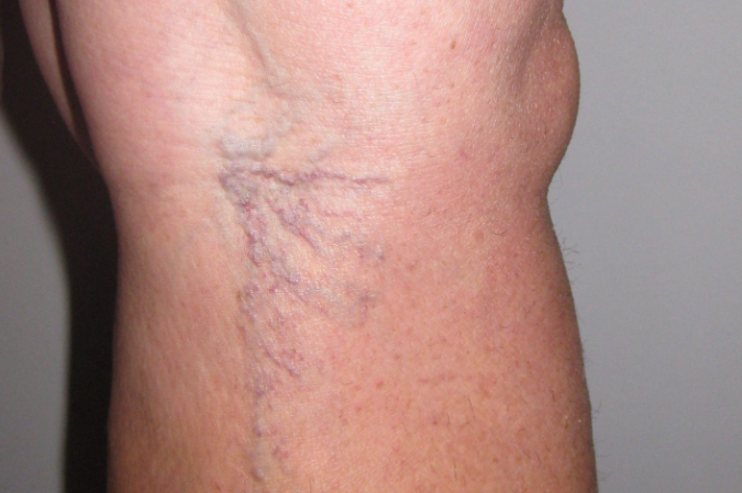 En México, 70 por ciento de los adultos tiene riesgo de padecer la enfermedad venosa crónica